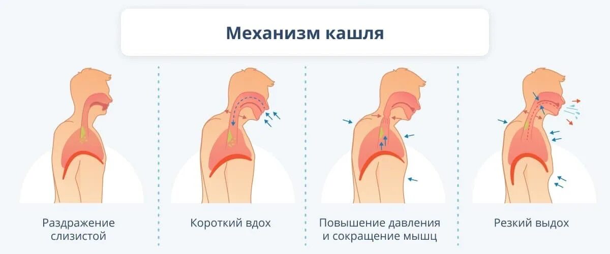 Кашель механизм происхождения. Механизм кашля схема. Механизм откашливания. Процесс кашля схема.