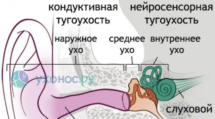 Нейросенсорная тугоухость фото. Восстановление слуха при нейросенсорной. Двусторонняя нейросенсорная тугоухость. Восстановление слуха при нейросенсорной. Сенсорная глухота.