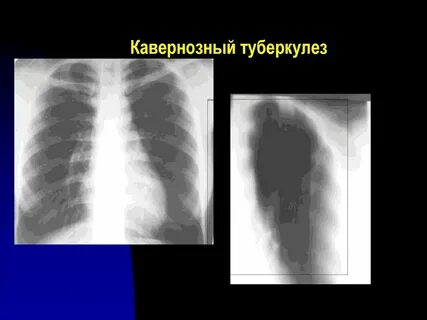 Диагностика туберкулеза рентген