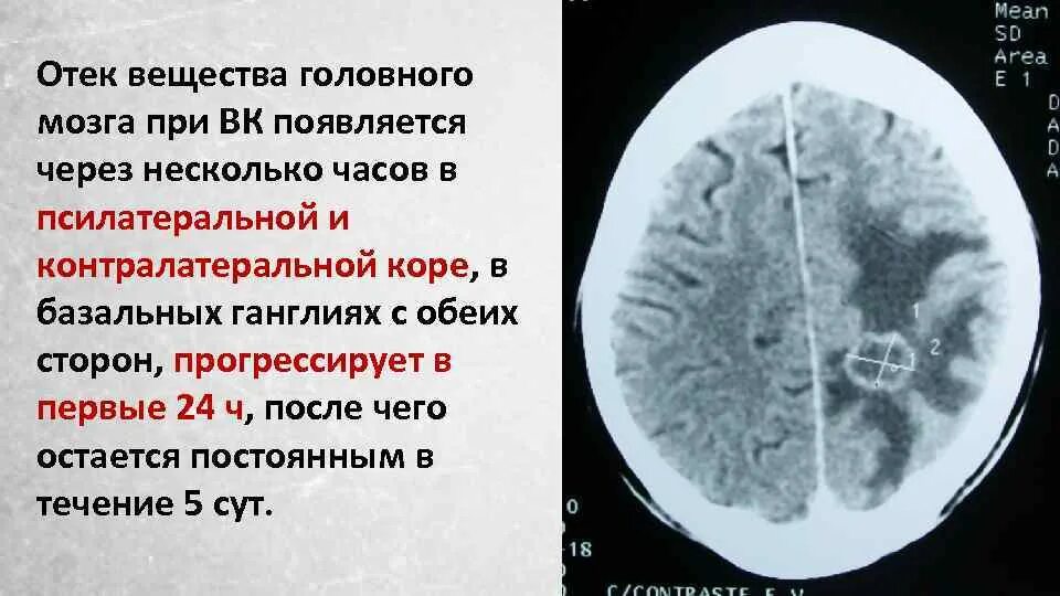 Отек белого вещества головного мозга кт. Диффузный отек головного мозга. Причины формирования отека головного мозга. Отек мозга осложнения