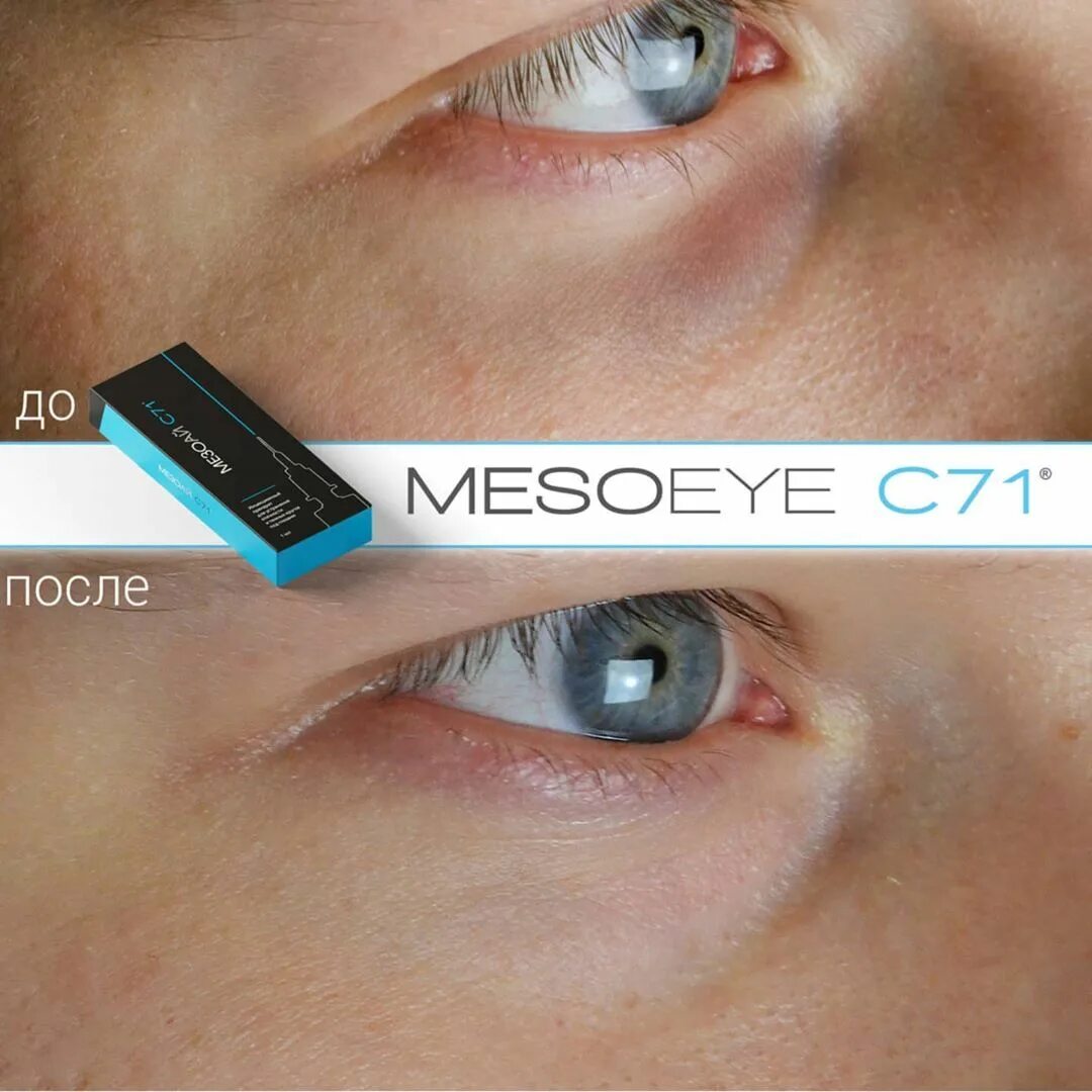 Мезо глаза отзывы. MESOEYE c71. МЕЗОАЙ С 71 под глаза. Meso-Eye c71 1,0 ml. Биоревитализация МЕЗОАЙ.