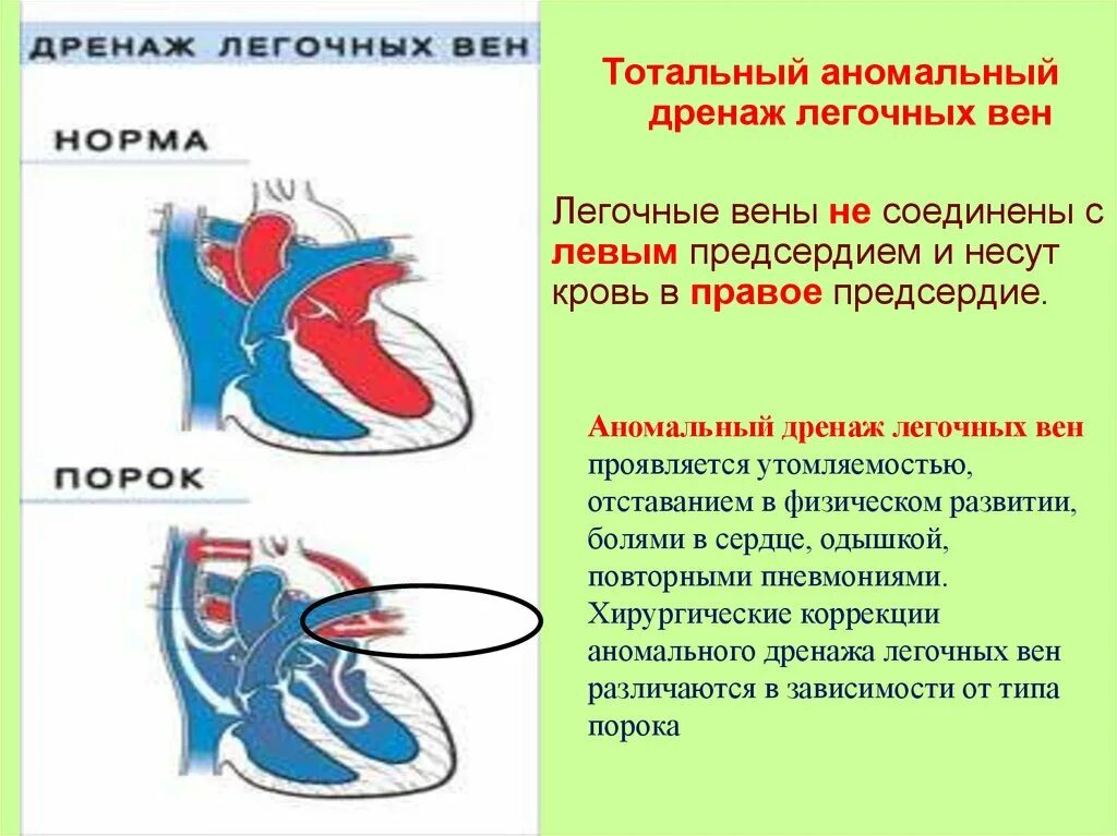 Несет кровь к предсердию. Тотальный аномальный дренаж легочных вен. Частичный аномальный дренаж легочных вен. ВПС аномальный дренаж легочных вен. Аномальный дренаж легочной артерии.