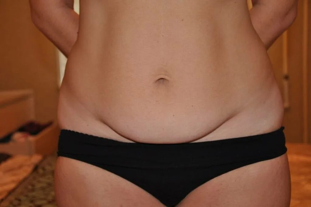 Страшные растяжки на животе. Толстый мужчина в бюстгальтере. Некрасивый живот. Абдоминопластика грыжа и диастаз. Некрасивый живот.