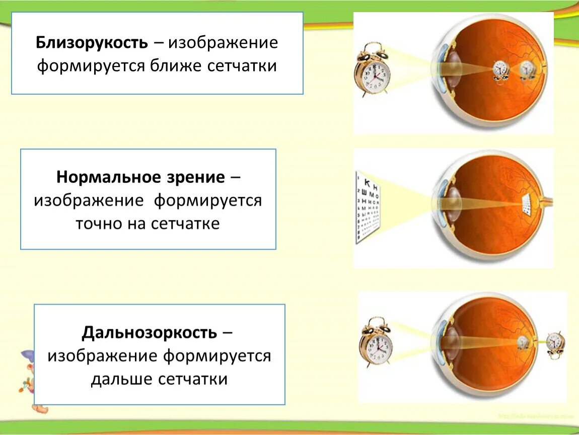 Какое изображение появляется на сетчатке глаза. На сетчатке формируется изображение. Близорукость картинки. Формирование изображения на сетчатке. Как формируется изображение на сетчатке.