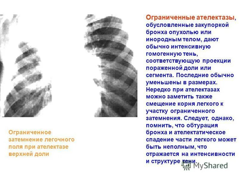 Затемнение верхней доли легкого. Ателектаз доли рентген. Ателектаз сегментарный на рентгенограмме. Ограниченное затемнение легочного поля. Ограничеенок затемне5ик легочнргг прля.