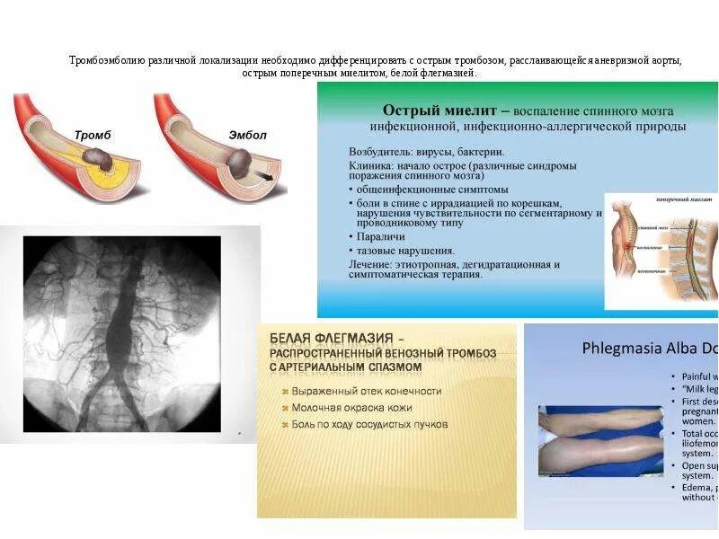 Тромбофлебит карта вызова. Острый тромбоз магистральных сосудов конечности. Острый тромбоз магистральных артерий клиника. Острый тромбоз магистральных артерий классификация. Острые артериальные тромбозы и эмболии магистральных сосудов.