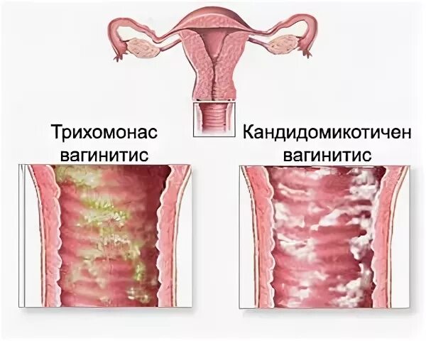 Стоматит или молочница? - 32 ответов форум Babyblog