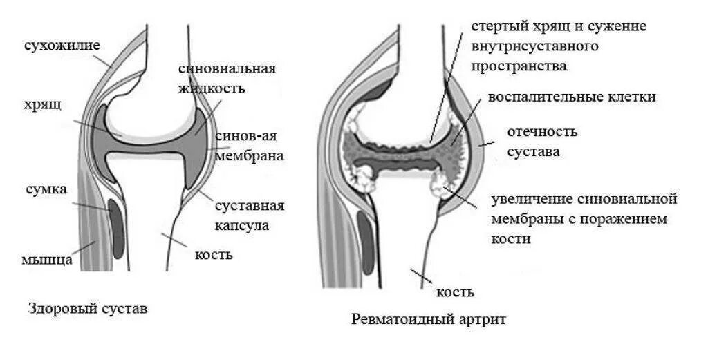 Чебоксары суставы операция. Схема суставов ревматоидный артрит. Ревматоидный артрит классификация коленный сустав. Ревматоидный артрит плечевого сустава мрт. Артрит коленного сустава схема.