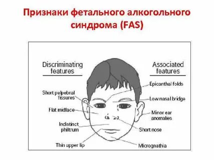 Дети с синдромом алкогольного лица