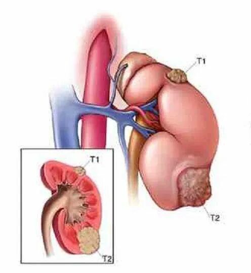Злокачественное новообразование почки. Злокачественная опухоль почки. Рак почки причины