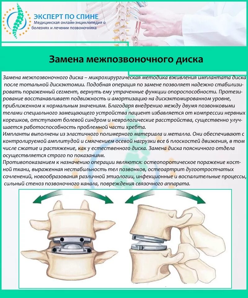 Операция имплант позвоночного диска. Схема замены позвоночного диска. Замена межпозвонкового диска поясничного отдела. Имплант при грыже позвоночника поясничного отдела. Операция на позвоночнике отзывы пациентов