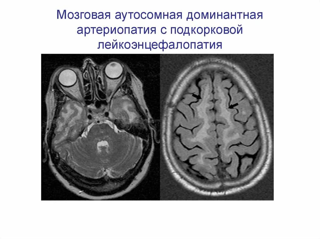 Рассеянный склероз лейкоэнцефалопатия. Церебрально аутосомно доминантный артериопатии. Прогрессирующая мультифокальная лейкоэнцефалопатия мрт. Поражение белого вещества мозга