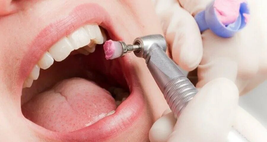 Чистить зубы после пломбы. Полости рта профгигиена полости рта. Чистить зубы после пломбы. Зондирование в стоматологии. Аппарат air flow в стоматологии.