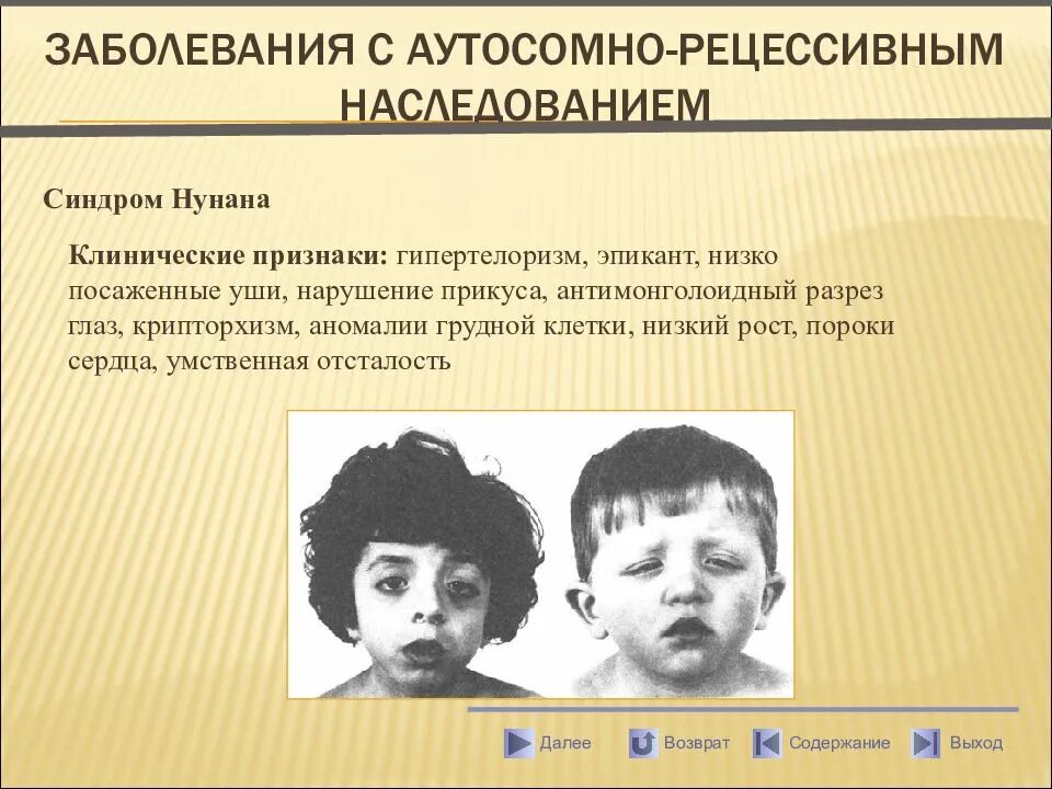 Синдром умственной отсталости