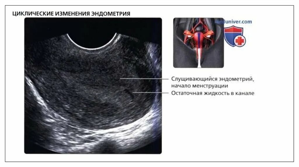 Можно делать узи перед месячными. Ультразвуковая анатомия матки. УЗИ матки перед месячными.