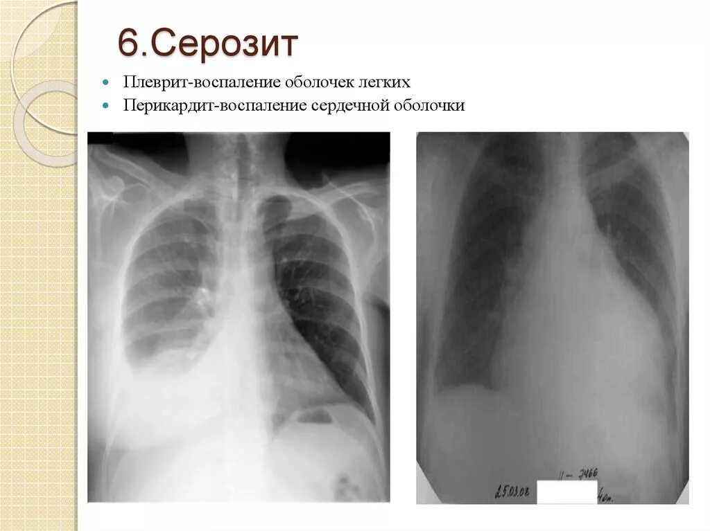 Оболочка легких 6. Плевральный выпот при СКВ. Серозит СКВ.