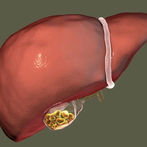 Холецистит камень в желчном пузыре