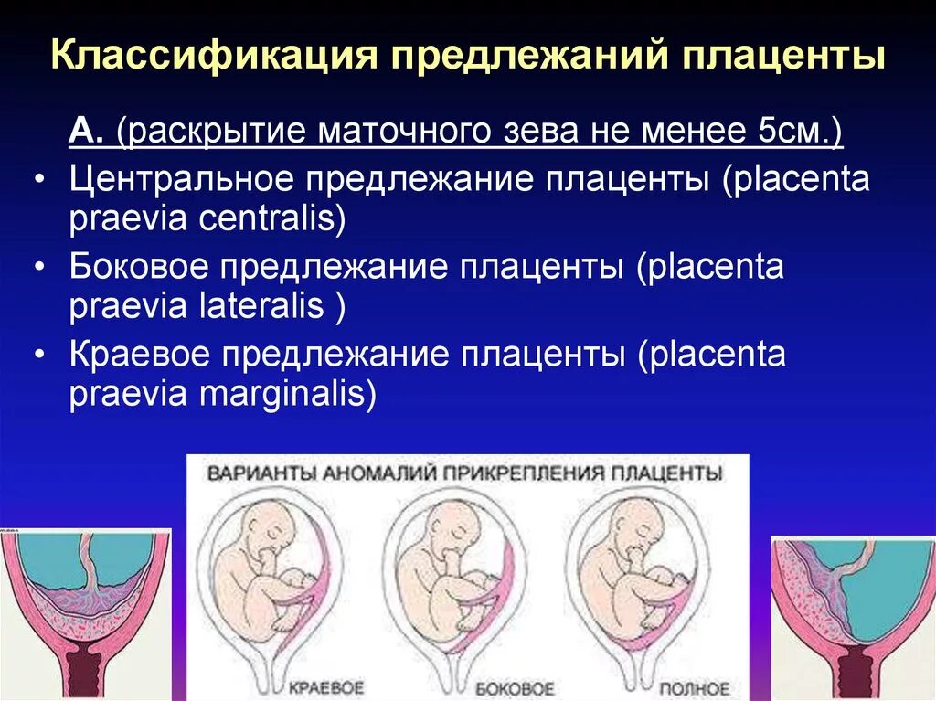 Самопроизвольное предлежание. Краевое предлежание плаценты. Центральное предлежание плаценты при беременности. Боковое и краевое предлежание плаценты. 5. Классификация предлежания плаценты..