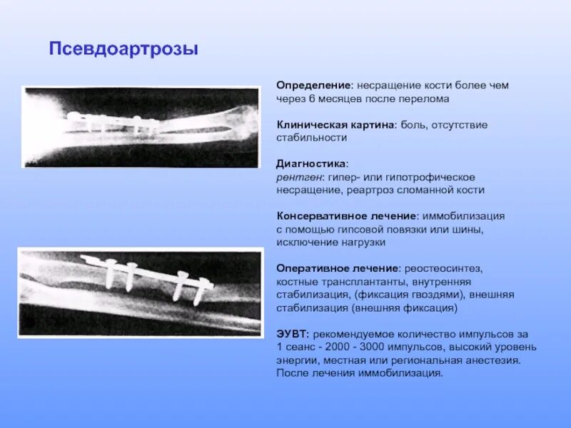Ложный сустав плечевой кости. Рентгенограмма костей голени в прямой проекции. Ложные суставы травматология. Гипертрофический ложный сустав. Причина ложного сустава.