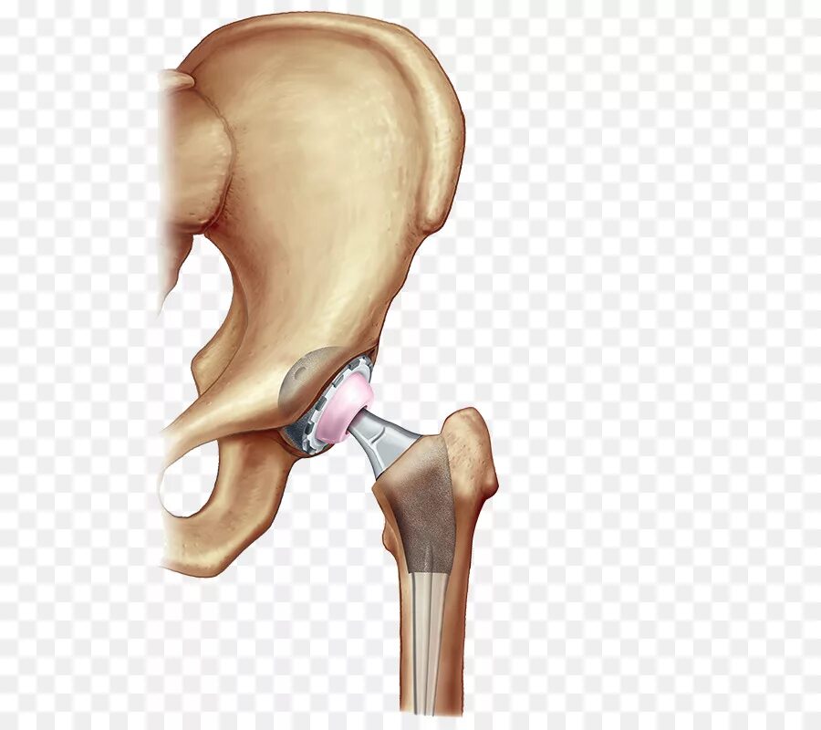 Эндопротез шейки бедра. Артроскопия тазобедренного сустава. Эндопротез коленного сустава Maxx Orthopedics. Эндопротез тазобедренного сустава PNG. Замена сустава шейки бедра
