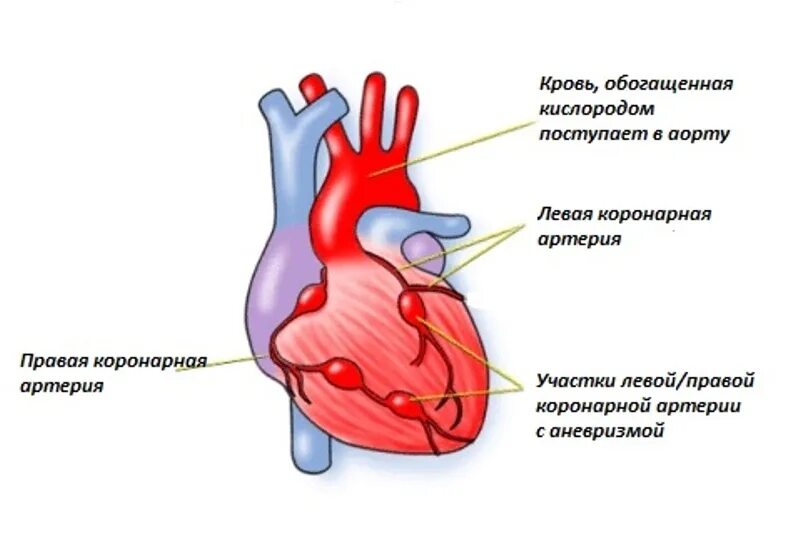 Аневризма сердца что это такое симптомы. Аневризма коронарной артерии. Кавасаки аневризма коронарных артерий. Аневризма коронарного сосуда. Острый аневризм сердца.