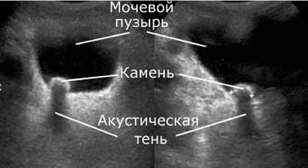 Акустические тени в почках. Камни в мочевом пузыре УЗИ. Конкременты мочевого пузыря на УЗИ. Камни в мочевом пузыре УЗИ фото. Камни в мочевом пузыре снимок УЗИ.