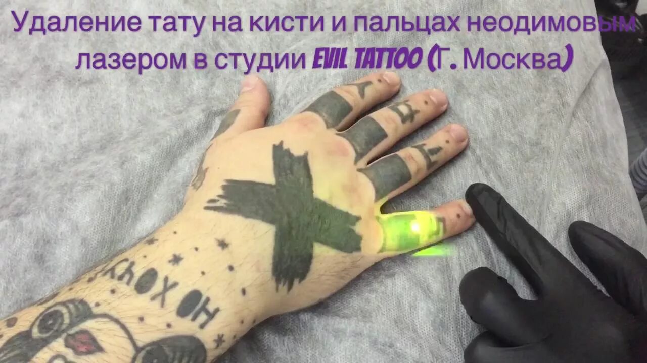 Стоит ли бить тату. Тату на кистях выведение. удаление тату лазером на кисти.