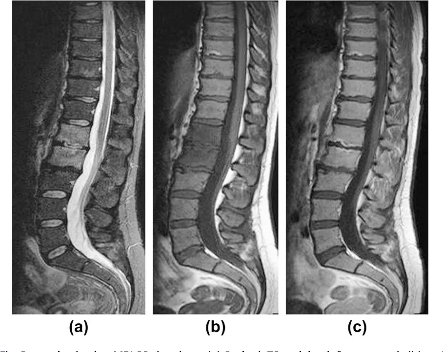 Modic 3 на мрт. Классификация модик мрт позвоночника. Modic 1 мрт. Модик 1- 3.