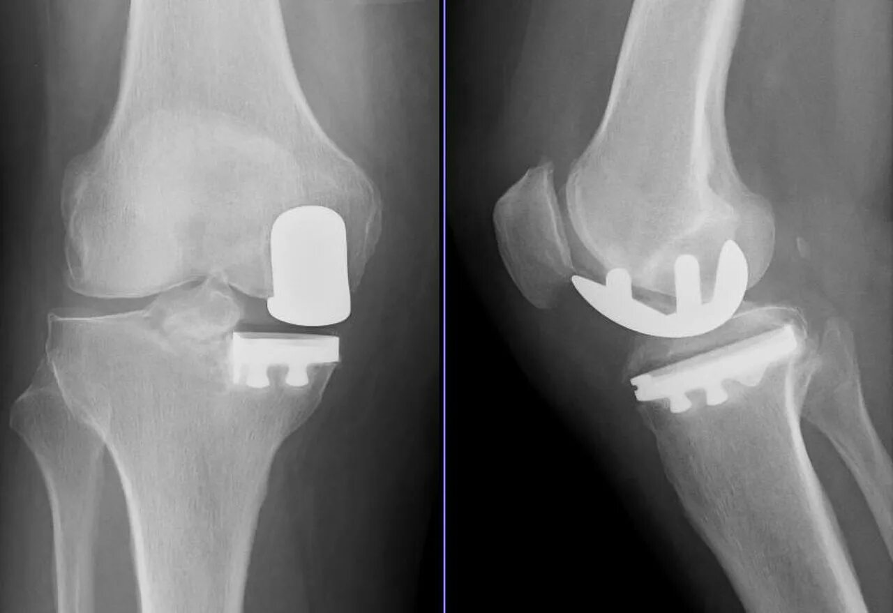 Частичное эндопротезирование коленного сустава рентген. Одномыщелковое эндопротезирование коленного рентген. Эндопротез коленного сустава рентген. Одномыщелковый эндопротез коленного сустава Oxford. Бесплатная замена коленного сустава