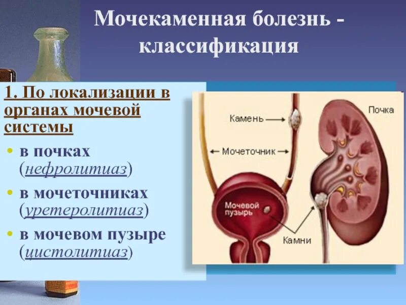 Мочекаменная болезнь мочевого пузыря. Пузырь в почках. Почечнокаменная болезнь камни. Мочекаменная болезнь (urolithiasis). Желчекаменная болезнь патанатомия.