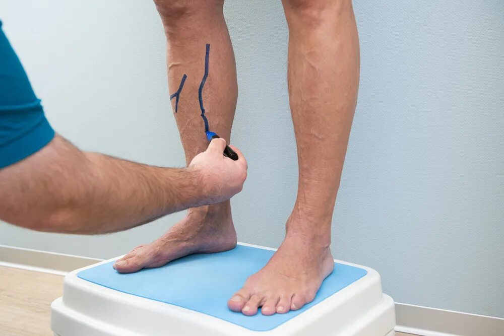 Лечение варикоза на ногах. Варикозное расширение вен реабилитация. Ноги после операции на вены.