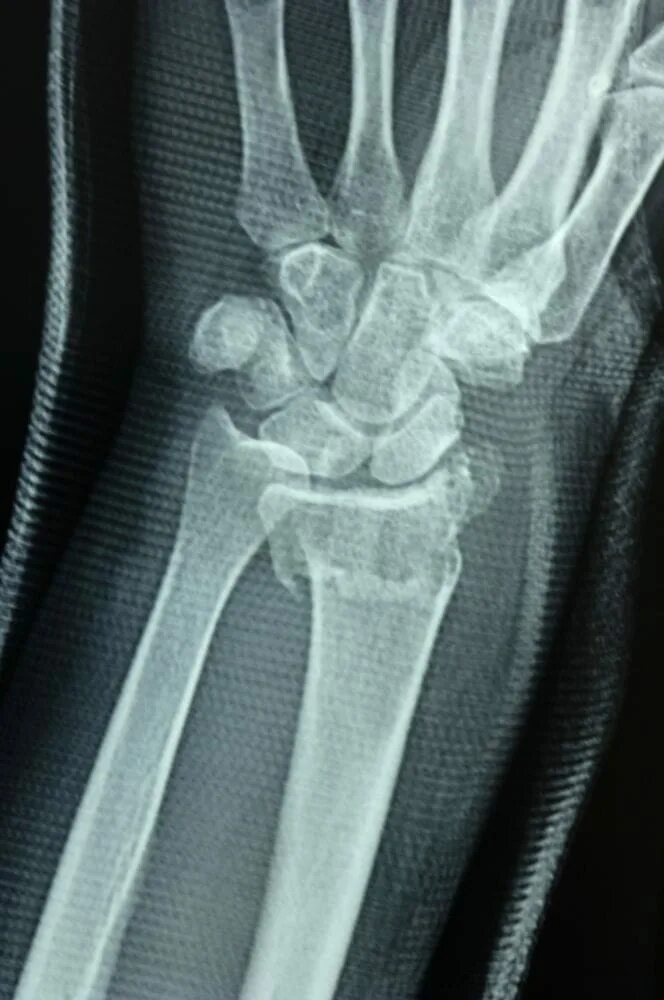 Диагноз перелома лучевой кости. Внутрисуставной перелом метаэпифиза лучевой кости. Перелом лучевой кости рентген. Рентген лучезапястный сустав перелом лучевой кости. Перелом ДМЭ лучевой кости рентген.