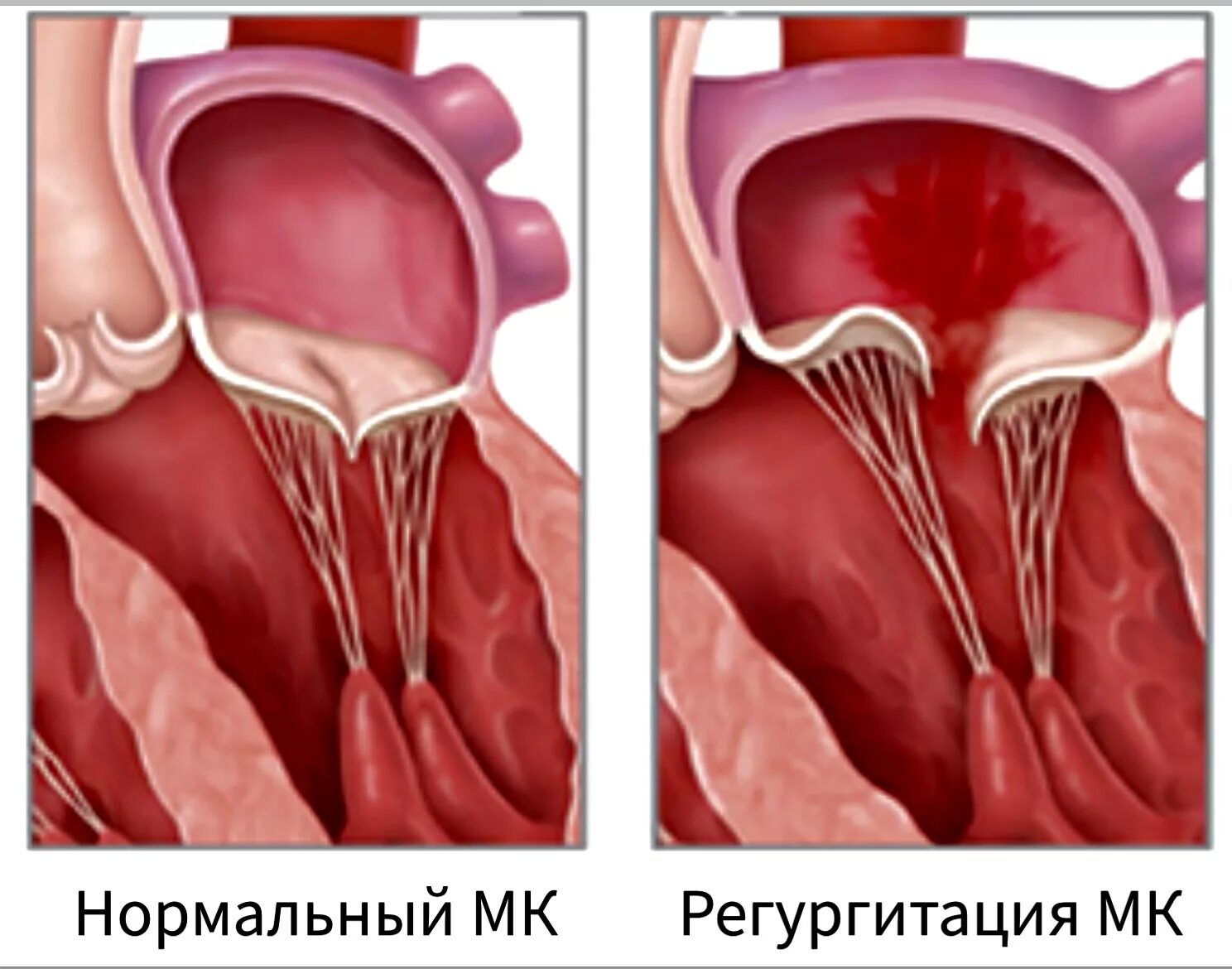 Что такое пролапс митрального клапана. Пролапс передней створки митрального клапана. Митральный клапан макропрепарат. Недостаточность митрального клапана 1 степени с регургитацией. Пролапс митрального клапана 1 степени.