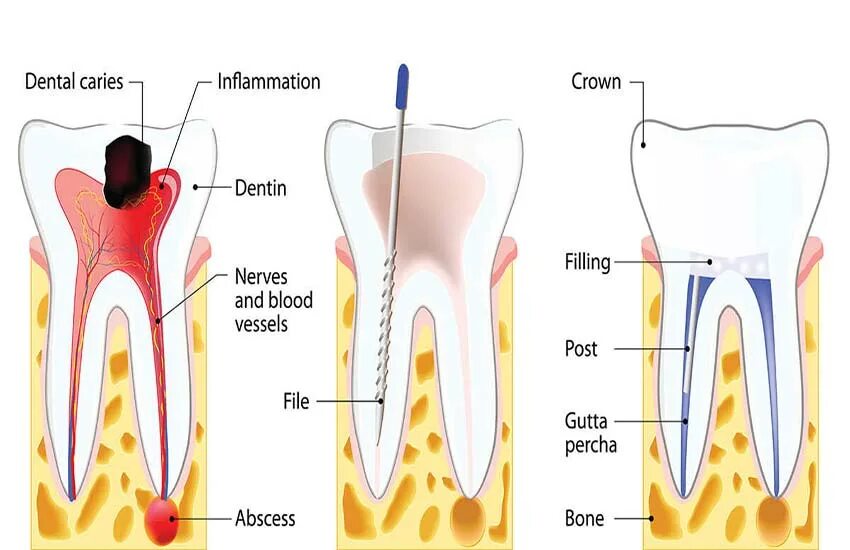 Root canal. Конкрементозный пульпит. Конкрементозный пульпит рентген. Хронический конкрементозный пульп. Конкрементозный периодонтит.