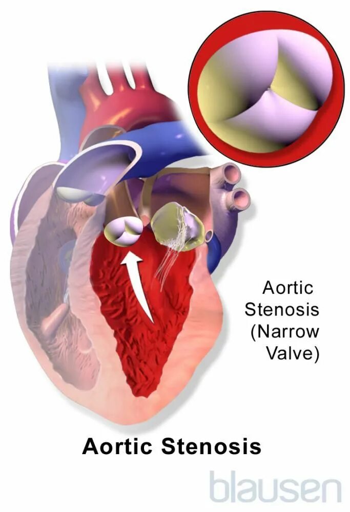 Сердечный стеноз. Порок сердца стеноз аортального клапана. Стеноз отверстия аортального клапана. Регургитация аортального клапана. Клапаны сердца аортальный клапан.