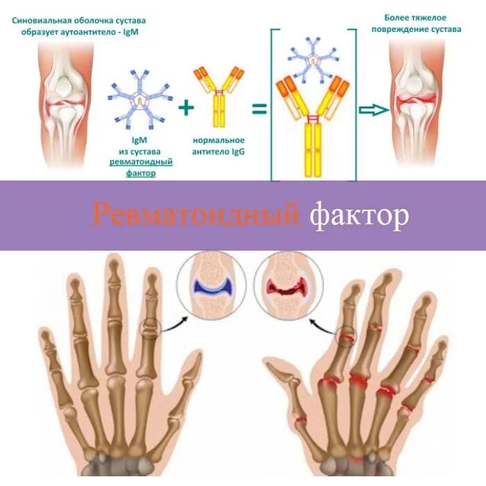 О чем говорит ревматоидный фактор. Ревматоидный фактор 40 ме/мл. Ревматоидный фактор IGM что это. Кровь на ревмофактор. Ревмофактор показатели.