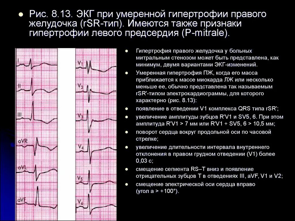 Диффузные изменения лж. ЭКГ при гипертрофии предсердий и желудочков сердца. Изменения на ЭКГ при гипертрофии левого желудочка. ЭКГ при гипертрофии левого желудочка. ЭКГ синдром гипертрофии желудочков.