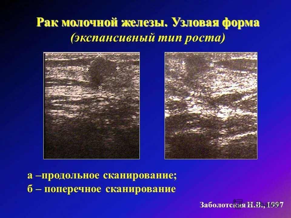 Опухолевидное образование молочной железы. Узловая форма мастопатии молочной железы на узи. опухоль молочной железы на узи. злокачественные образования молочной железы на узи. карцинома грудной железы узи.
