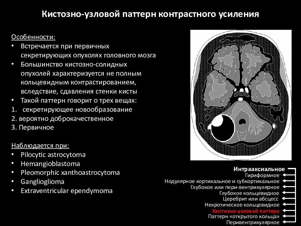 Разница кт и кт с контрастом. Абсцесс головного мозга кт протокол. Кистозная опухоль головного мозга кт. Контрастное усиление при кт. Кистозно-Солидное образование головного мозга.