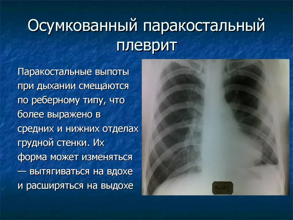 Плевральные осложнения. Паракостальный осумкованный выпот рентген. Левосторонний плеврит рентген осумкованный. Туберкулезный плеврит осумкованный рентген. Туберкулезный экссудативный плеврит рентген.