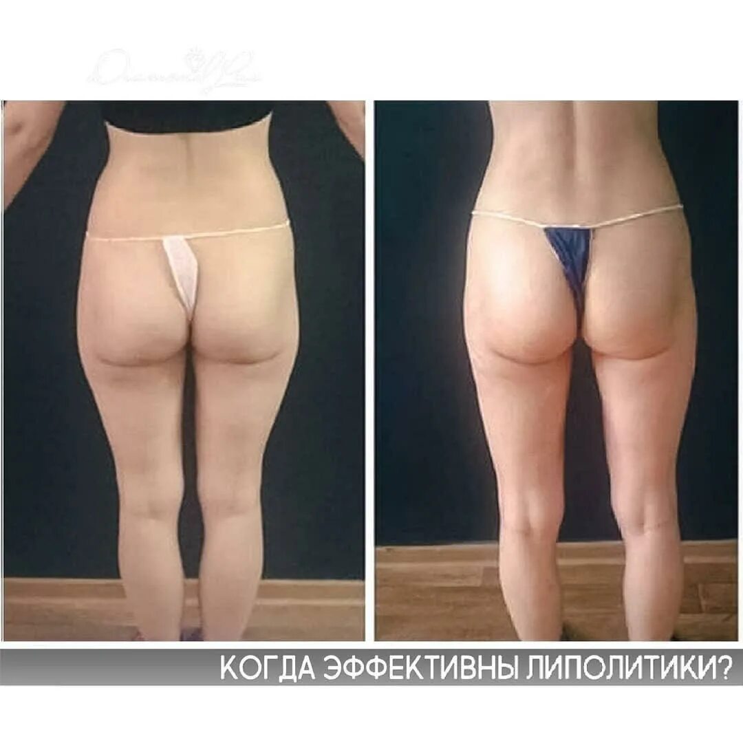 Липолитики что это. Липолитики в галифе. липолитики в ушки на бедрах. липолитики в бедра.