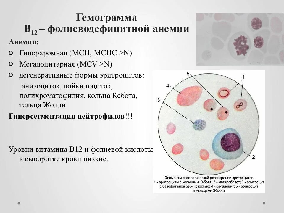 В12 в эритроцитах. Тельца жолли и кольца кебота. в12 фолиеводефицитная анемия картина крови. в12-фолиеводефицитной анемии эритроциты. б 12 дефицитная анемия картина крови.