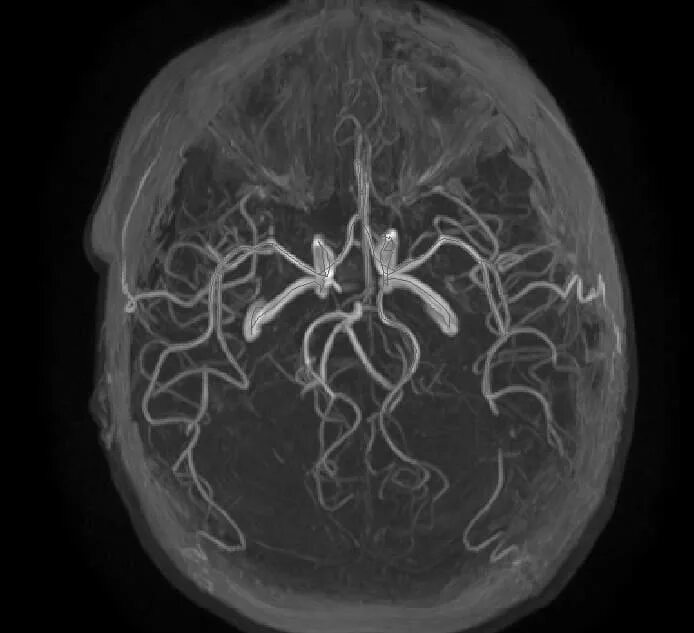 МСКТ ангиография головного мозга. Рентген МСКТ ангиография.