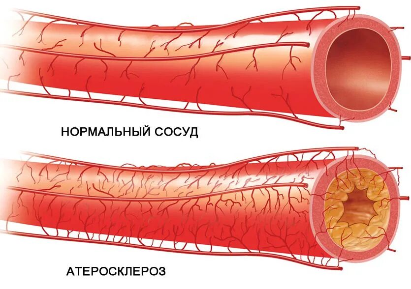 Атеросклеротические атеросклеротические поражения конечностей. Атеросклеротическое поражение коронарных сосудов. Атеросклероз аорты и коронарных артерий. Атеросклероз коронарных артерий сосуды. Атеросклеротическая бляшка коронарного сосуда.