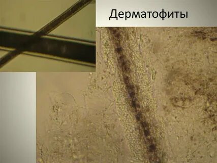 Соскоб на патогенные грибы