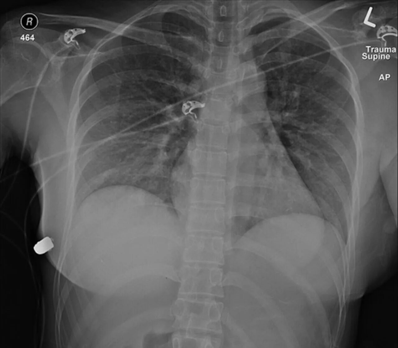 Два выстрела в сердце. Рентгеновский снимок груди женщины. Импланты на рентгене грудной клетки. Снимок грудной клетки женщины.
