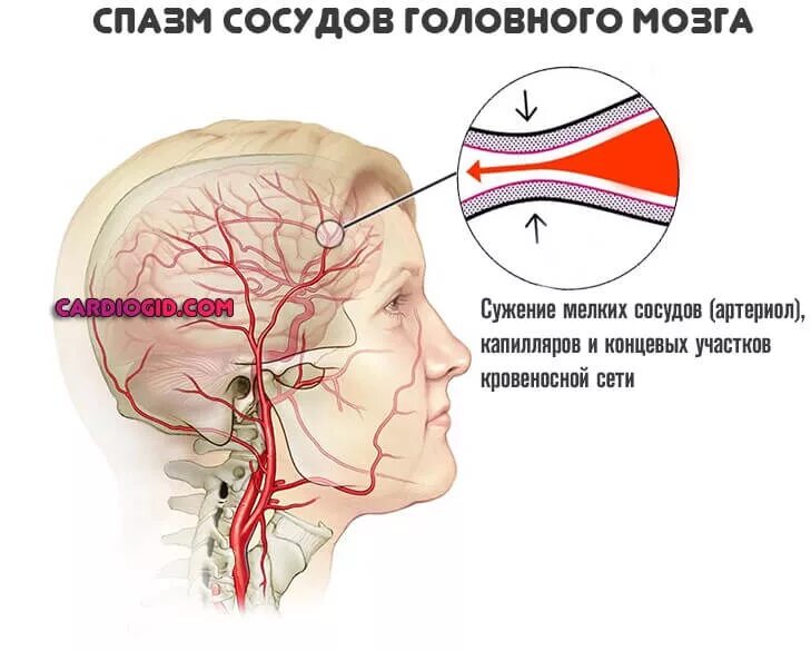 Спазмы сосудов головного мозга. Сосудистый спазм головного мозга. Сокращение сосудов головного мозга.