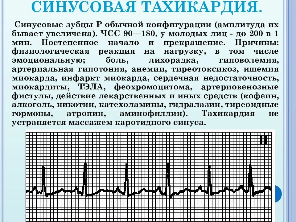 Сильное сердцебиение при нагрузках. Синусовая тахикардия ЧСС 100 ЭКГ. Синусовая аритмия тахикардия. Синусовая тахикардия на ЭКГ. Синусовая тахикардия клиника.