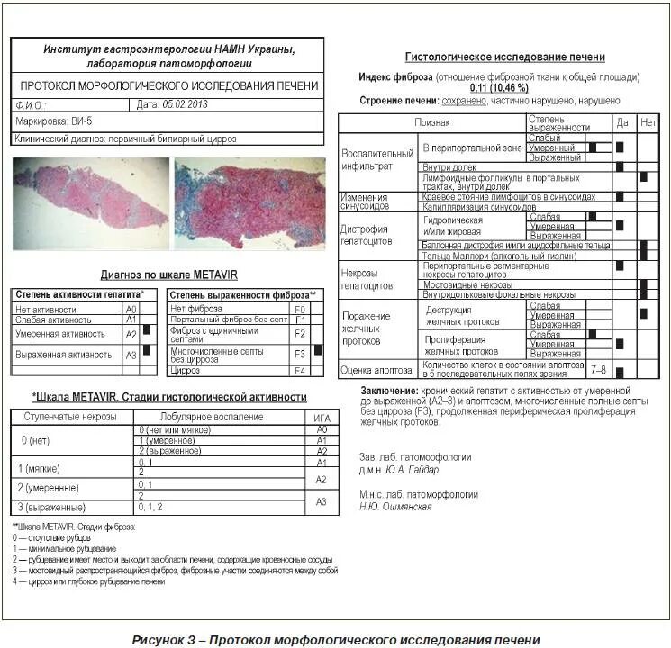 Фиброзные изменения печени. Стадии фиброза печени по шкале. Хронический гепатит шкала metavir. Фиброз печени f1 по шкале metavir. Фиброз печени 3 стадии.