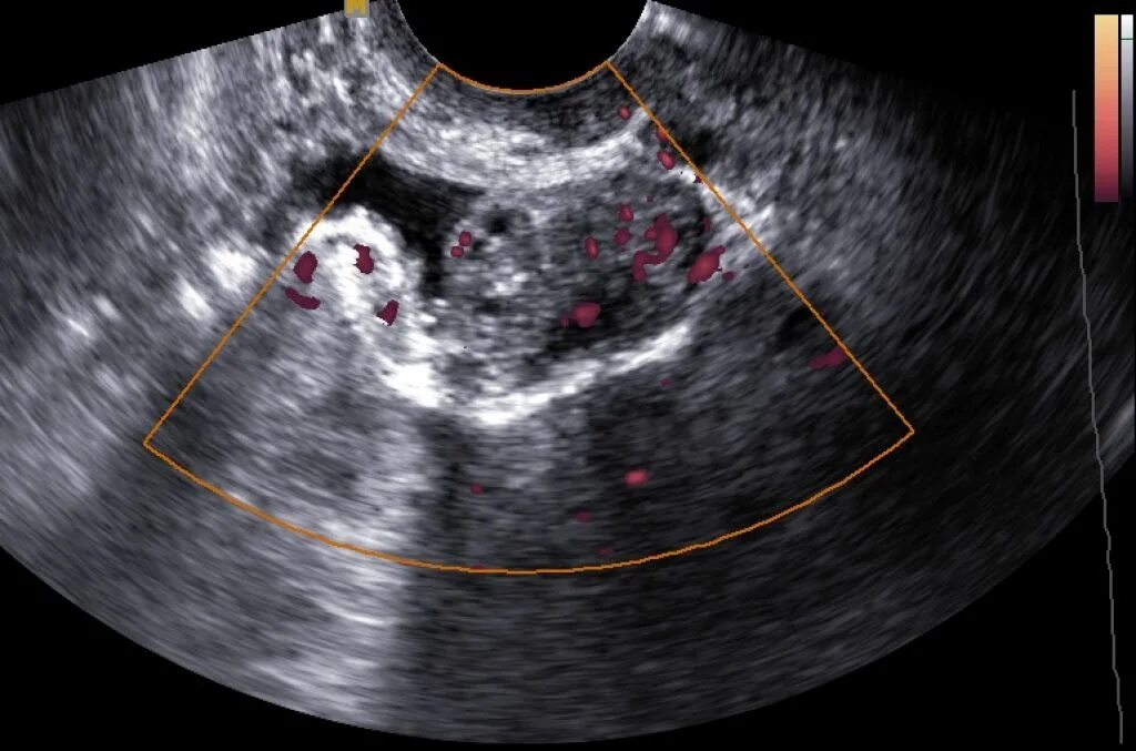Отслойка эндометрии. Эндометриоз мочевого пузыря на УЗИ. Эндометриоз маточной трубы УЗИ.